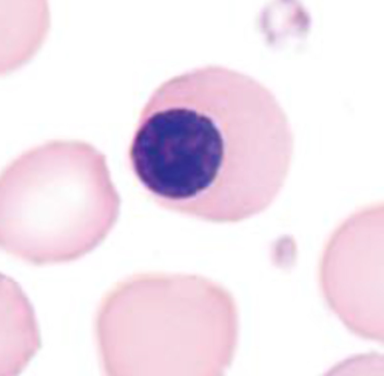<p>Metarubicyte/ Orthochromic normoblast/ Orthochromic Erythroblast<br>- 45% nucleus<br>- very tight nucleus<br>- orangey cytoplasm<br>- 1-5% BM</p>