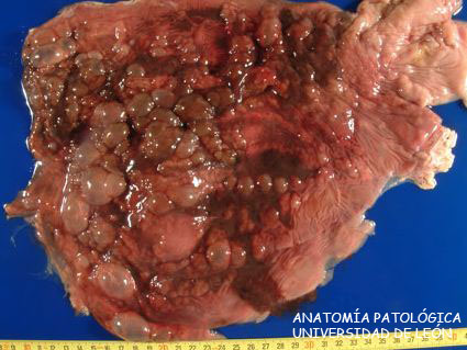 <p>Abomasitis enfisematosa y enteritis hemorrágica. Ternero.</p>
