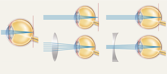 <p><span><span>•Light is refracted (bent) as it passes through the cornea and lens</span></span></p><p><span><span>•Image upside down and reversed</span></span></p><p><span><span>•Light passing through the center of the cornea is not bent</span></span></p><p><span><span>•Cornea refracts light more than lens does</span></span></p><p><span><span>–Lens merely fine-tunes image</span></span></p><p><span><span>–Lens can change shape and become rounder to increase refraction for near vision (</span><strong><span>accommodation</span></strong><span>)</span></span></p>
