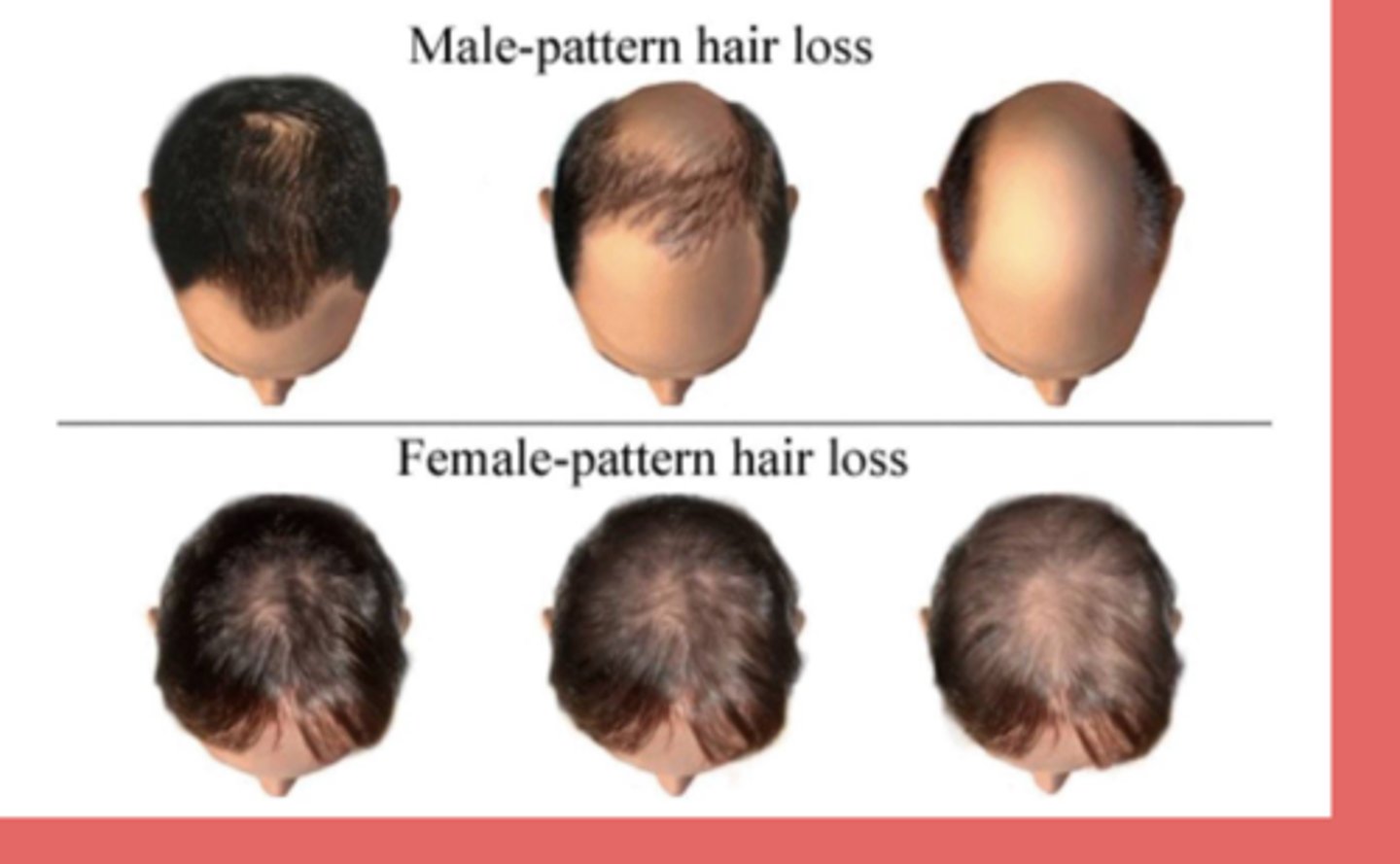 <p>androgenic alopecia → MC type of hair loss in M&amp;F</p><p>- males: bitemporal thinning &amp; vertex scalp</p><p>- females: vertex scalp (doesn't affect frontal hairline)</p><p>DHT (key androgen) shortens the anagen phase</p><p>anagen = growth phase</p><p>telogen = resting phase </p><p>tx = topical minoxidil, PO finasteride, spiro</p>
