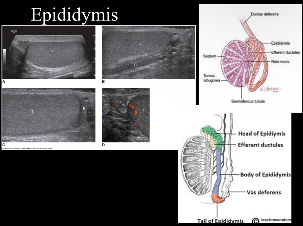 <p>Body tends to be isoechoic or slightly less echogenic than globus major and testis. What does epididymis look sonographically?</p>