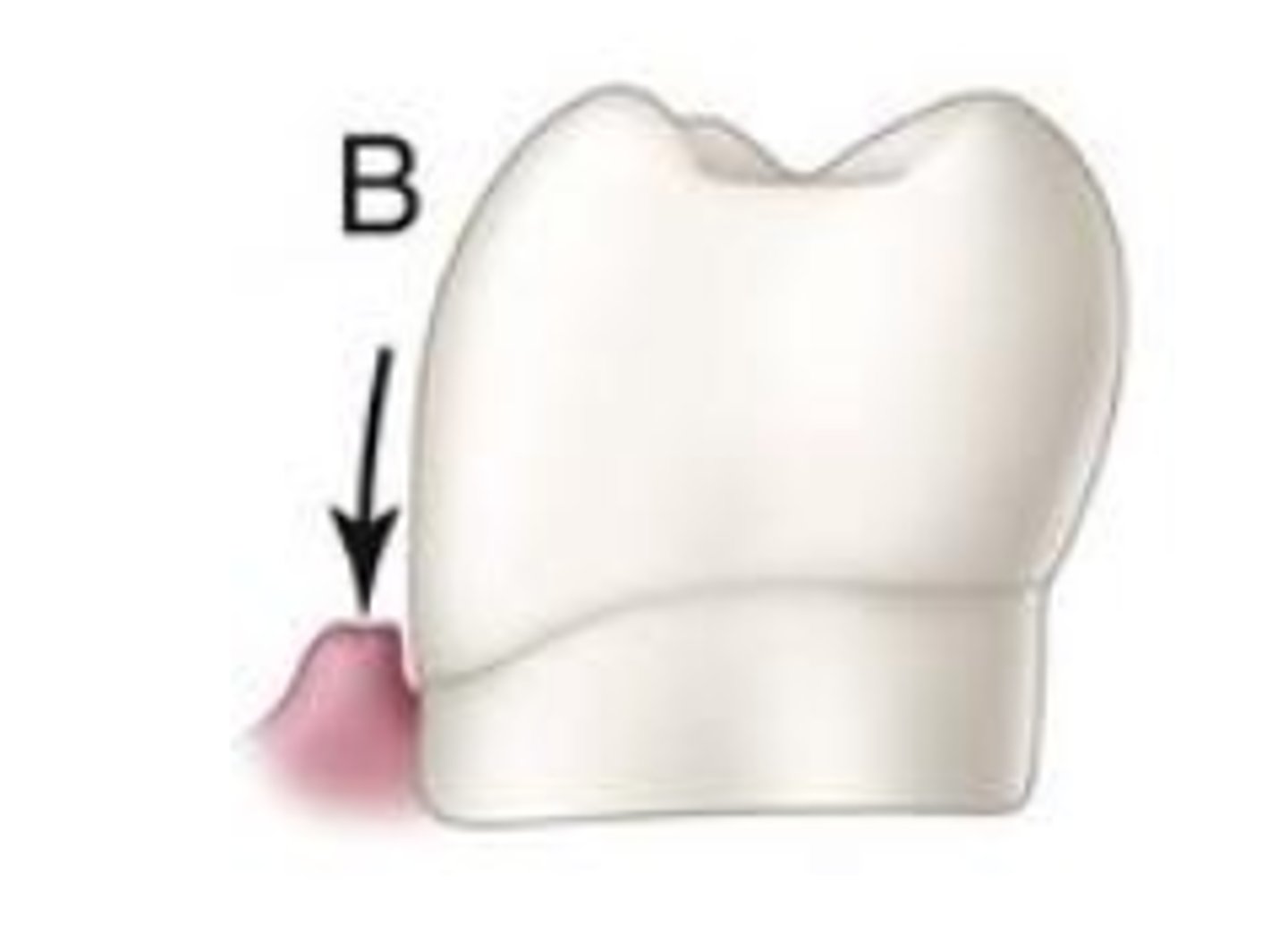 <p>Under-contour of tooth may result in...</p>