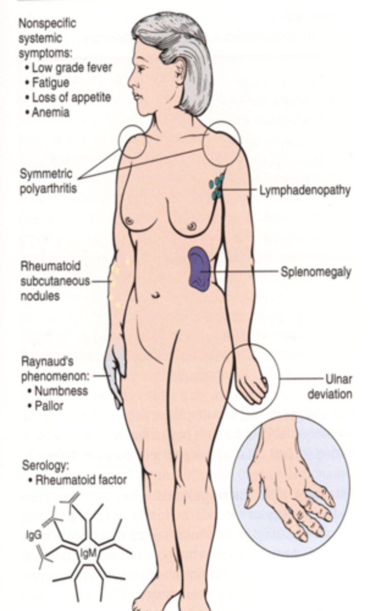 <p>-symmetric pain and swelling, prolonged morning stiffness (1 hr +), malaise, fatigue, and low-grade fever</p><p>-PIP, MCP, and thumb joints, wrist, elbow, ankle, MTP, and temporomandibular joints (jaw); the hips, knees, shoulders, and cervical spine</p>