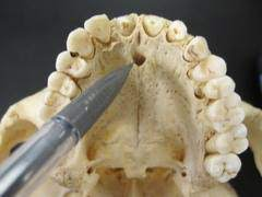 <p>anterior hard palate at midline</p>
