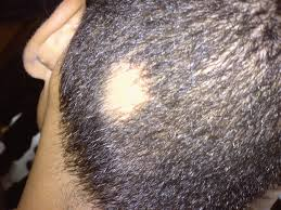 <p>E: autoimmune dx<br>-totalis (scalp)<br>-universalis (whole body)</p><p>CM: non-scarring<br>1+ round/oval patches (1-5 cm)<br><strong>exclamation point hairs</strong></p><p>TX:<br><u>localized:</u><br>intralesional/topical triamcinolone</p><p><u>extensive:</u><br>topical immunotherapy<br>PO JAK inhibitors<br>off-label tx</p>