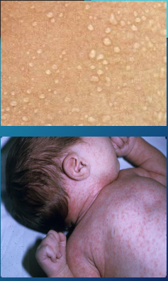 <p><strong>Miliaria: Crystallina and Rubra</strong></p><p>-Crystallina&nbsp;</p><ul><li><p>Common in ___________ but can happen at any age&nbsp;</p></li><li><p>Blockage of duct within the _______ ________</p></li><li><p>Small, thin walled _________&nbsp;“dew drops” _________ inflammation</p></li><li><p>Most common on the _____, neck, and upper trunk&nbsp;</p></li></ul><p>-Rubra</p><ul><li><p>Most common type&nbsp;</p></li><li><p>Blockage of duct within the ________ or dermis&nbsp;</p></li><li><p>_________ of sweat into surrounding tissue → _____________ response</p></li><li><p>Small, ____________ papular, papulovesicular, or papulopustular lesions&nbsp;</p></li><li><p>Most common in skin folds of the neck, _______, or groin&nbsp;</p></li></ul><p></p>