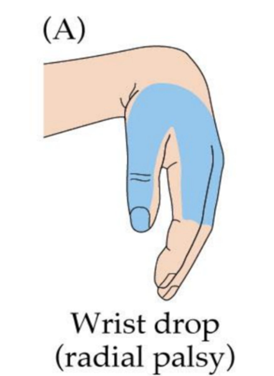 <p>Wrist drop</p>