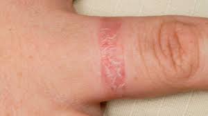 <p>a general term that describes inflammation of the skin, a common cause of dermatitis is contact with something that irritates your skin or triggers an allergic reaction.</p>