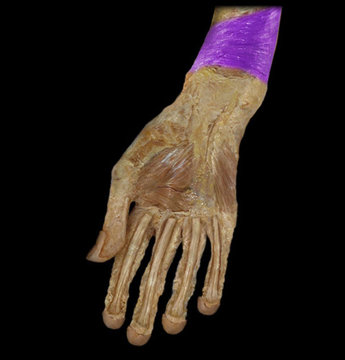 <p>deep square shaped muscle of the anterior wrist</p><p>Pronator of forearm at radio-ulnar joint</p><p>Proximal to distal ulna</p><p>Distal to distal radius</p>