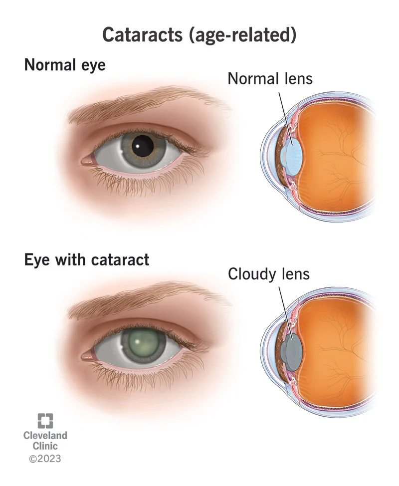 <p>As an individual ages the proteins in the lens of the eye start to break down and clump together. This clump makes a cloudy area on the lens — known as a cataract.</p>