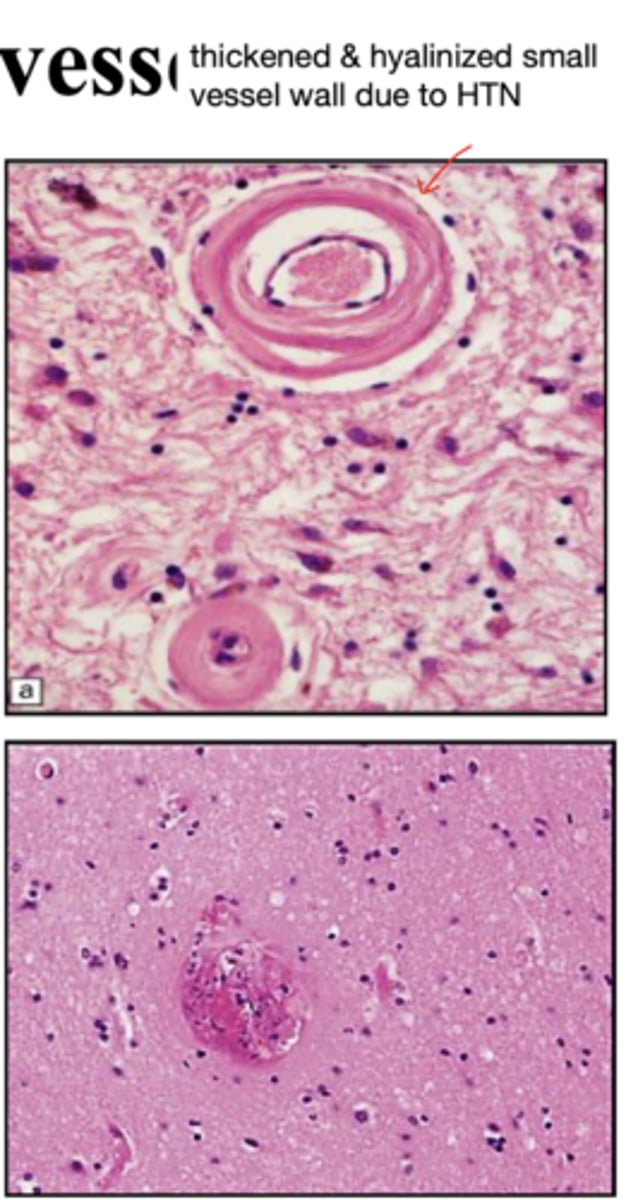 <p>hypertensive small vessel disease:</p>