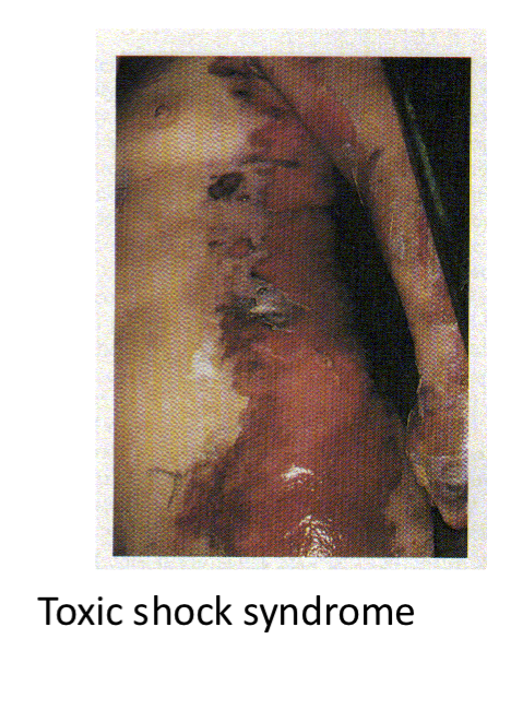 <p>Toxemia leading to shock and organ failure.</p>