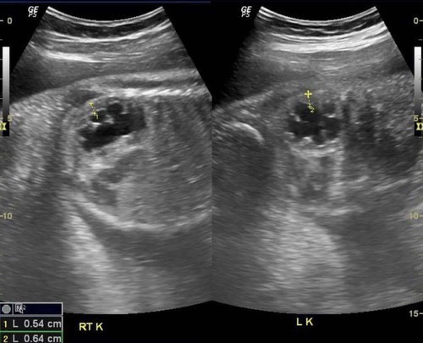 <p>Pelvis is > 10 mm</p><p>Marked dilation of calyces</p><p>Mild thinning of cortex</p>