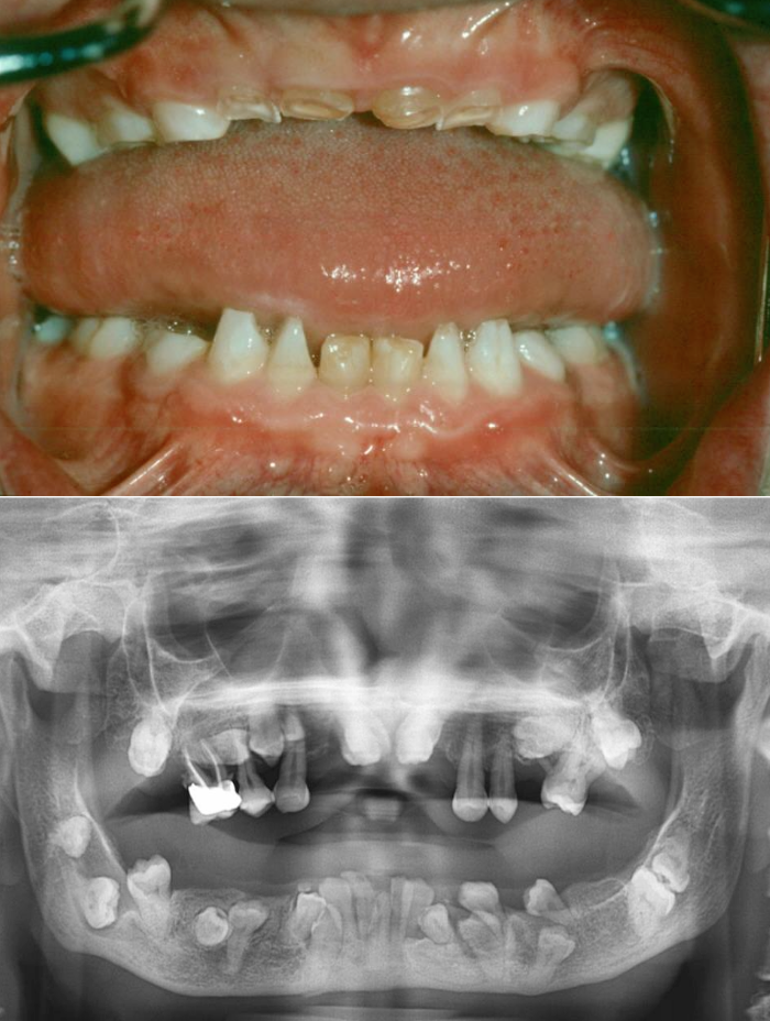 <ul><li><p>Patients have a high-arched palate</p></li><li><p>Increased prevalence of cleft palate</p></li><li><p>Mandibular prognathism</p></li><li><p><strong>Prolonged retention</strong> of deciduous teeth</p></li><li><p>Delay or <strong>failure of eruption</strong> of permanent teeth</p></li><li><p>Abnormally shaped teeth</p></li><li><p><strong>**Numerous unerupted permanent and supernumerary teeth**</strong></p></li></ul><p></p>