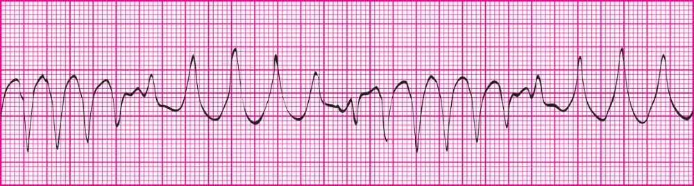 <p>Depolarization impulses move from one ventricle to the other;  occurs due to electrolyte deficiencies; treatment includes magnesium sulfate</p><p></p><p>Rhythm: P-P interval usually not identifiable; R-R interval usually regular, can be slightly irregular at times.</p><p>Rate: Ventricular rate- 100‒200 beats per minute; Atrial rate- Cannot be determined</p><p>P wave: Absent</p><p>PR interval: Cannot be determined</p><p>QRS: Duration greater than 0.12 second; Wide, bizarre appearance; T wave in opposite direction (usually down) from QRS complex</p><p></p><p>Lost atrial kick and decreased ventricular filling time result in decreased cardiac output.</p><p>Approximately 50% of patients become unconscious immediately.</p><p>Notify licensed practitioner immediately.</p><p>Save rhythm strips in medical record to document rhythm changes.</p>