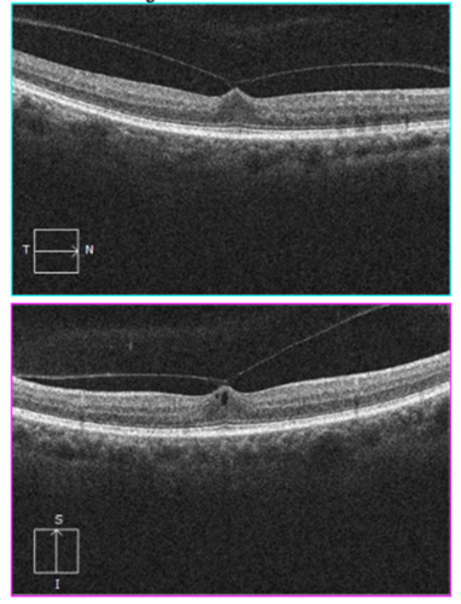 <p>traction of retina by posterior hyaloid right before vitreous fully detaches from fovea = distortion of retinal layers, cystic spaces = tear/hole</p>