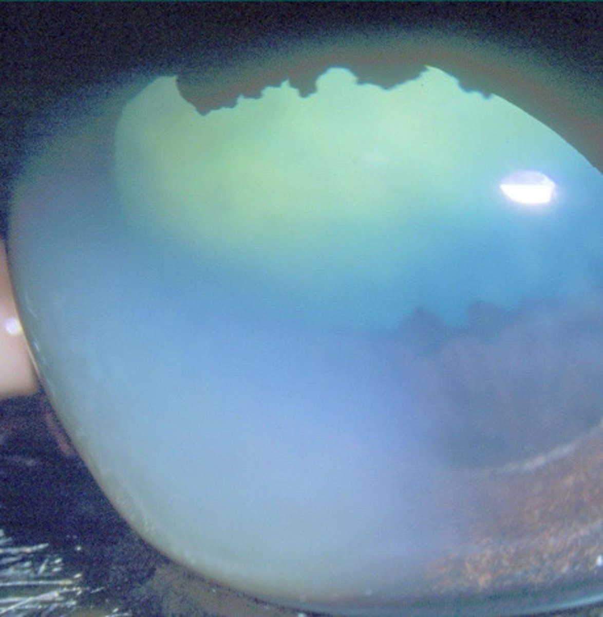 <p>What is happening in this eye, where deep in the cornea there is central edema which has the potential to cause "melting"?</p><p>a. immune mediated epithelial keratitis</p><p>b. chronic SUPERFIICAL stromal immune mediated keratitis</p><p>c. chronic RECURRENT DEEP stromal immune mediated keratitis</p><p>d. eosinophilic keratitis</p><p>e. immune mediated endothelitis</p>