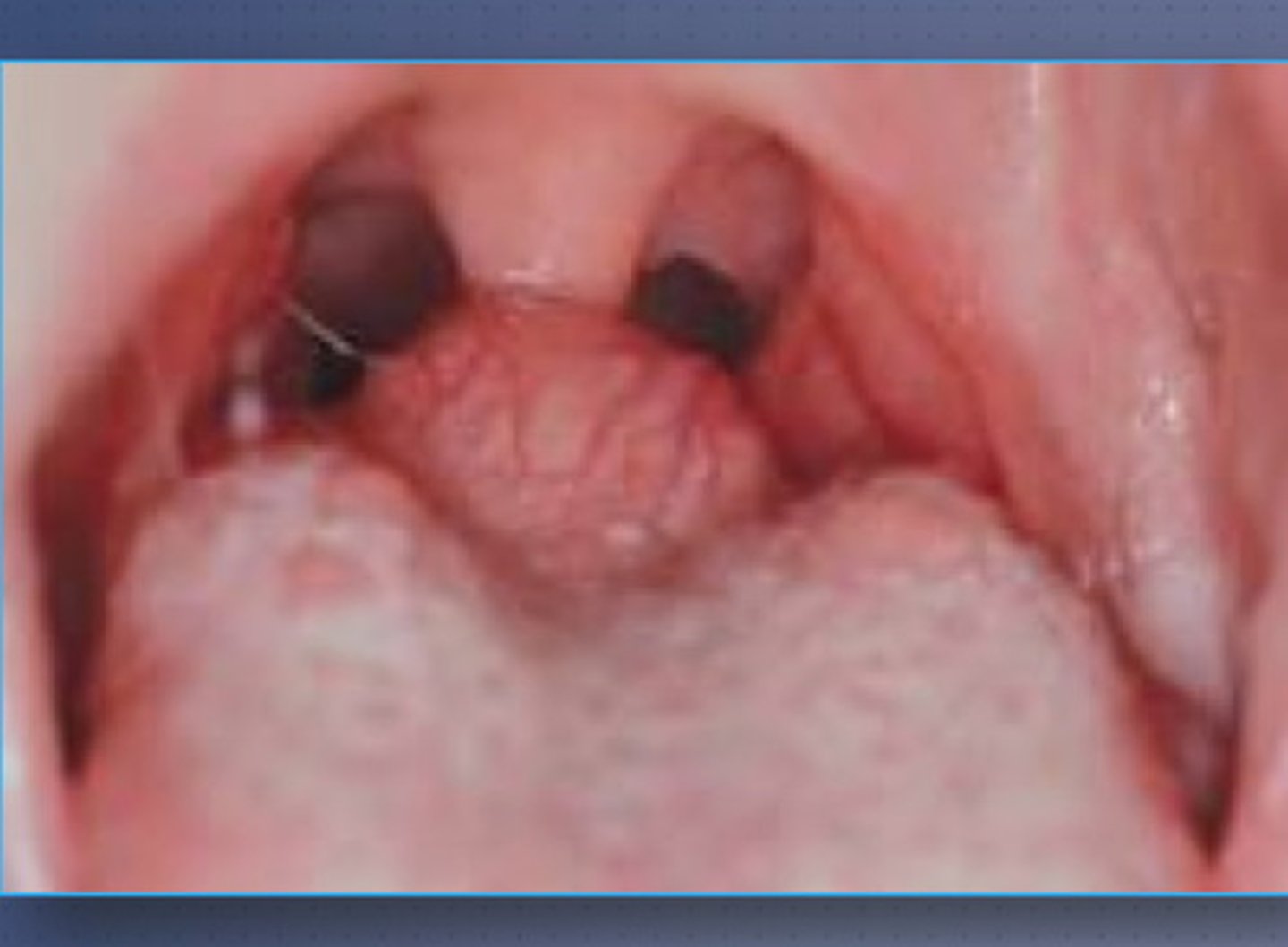 <p>Thyroid gland is located in other parts of the body than where it should be. Mostly superior to its standard position.</p><p>This condition can lead to hyperthyroidism </p>