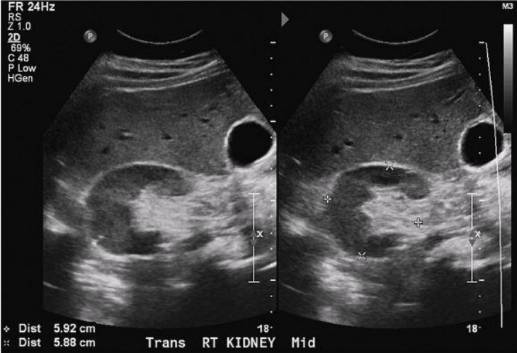 <p>Area through which renal artery, vein, nerves, and ureter enter the kidney</p>