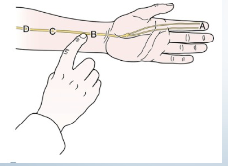 <p>Tinel’s at the Wrist</p>