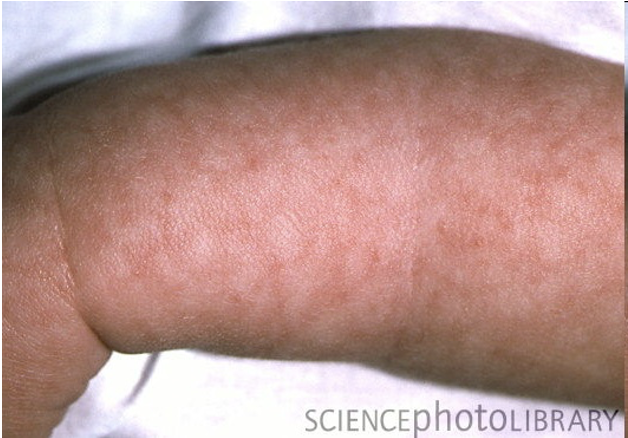 <p>Flat rash all over the body</p>