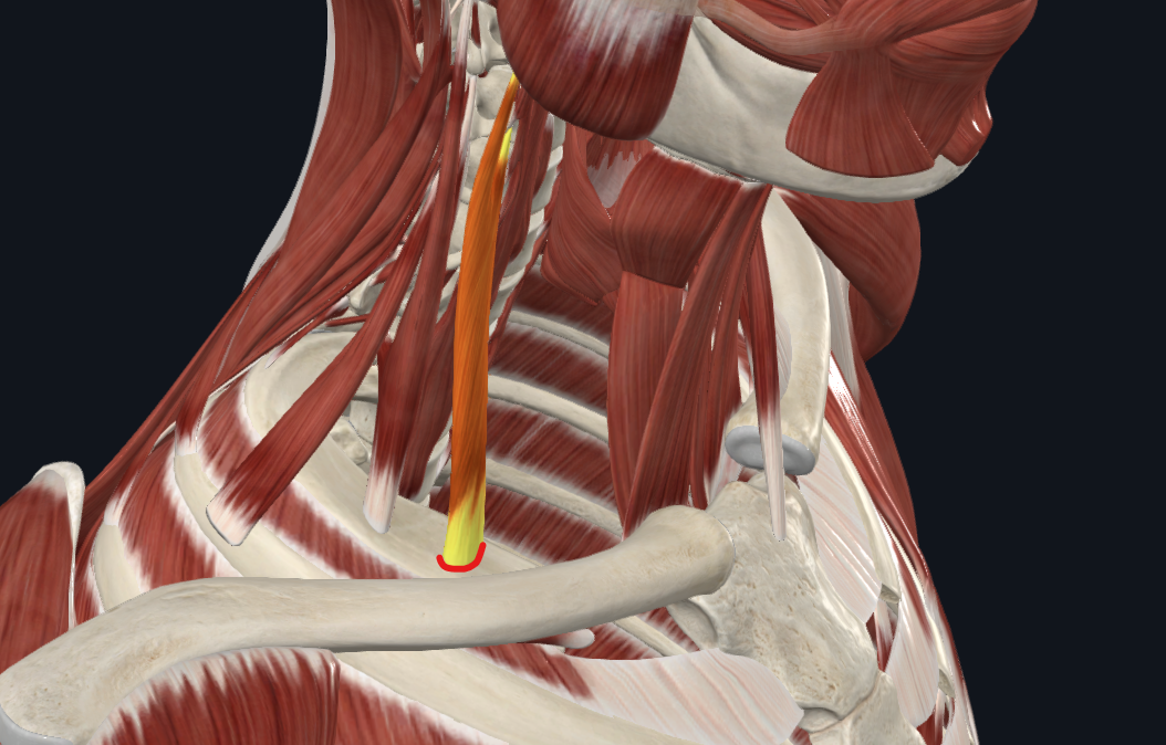 <p><strong>Nombre alterno: </strong>X</p><p><strong><mark data-color="yellow" style="background-color: yellow; color: inherit">Origen: </mark></strong><mark data-color="yellow" style="background-color: yellow; color: inherit">Tubérculos anteriores de apófisis transversas de C3-C6</mark></p><p><strong><mark data-color="blue" style="background-color: blue; color: inherit">Inserción: </mark></strong><mark data-color="blue" style="background-color: blue; color: inherit">Tubérculo de Lisfranc</mark></p><p><strong><mark data-color="red" style="background-color: red; color: inherit">Acción:</mark></strong></p><p><mark data-color="red" style="background-color: red; color: inherit">Costillas Fijas y solo uno: Inclina columna vertebral hacia dicho lado (lateraliza cuello)</mark></p><p><mark data-color="red" style="background-color: red; color: inherit">Contracción simultánea: Rigidez en columna cervical</mark></p><p><strong><mark data-color="purple" style="background-color: purple; color: inherit">Inervación: </mark></strong><mark data-color="purple" style="background-color: purple; color: inherit">Nervios cervicales C4-C6</mark><strong><br><mark data-color="green" style="background-color: green; color: inherit">Relaciones: </mark></strong><mark data-color="green" style="background-color: green; color: inherit">Adelante vena subclavia, atrás arteria subclavia, plexo braquial</mark></p><p><strong>Notas:</strong></p><p>Segundo plano</p><p>Agonista del ECM</p>