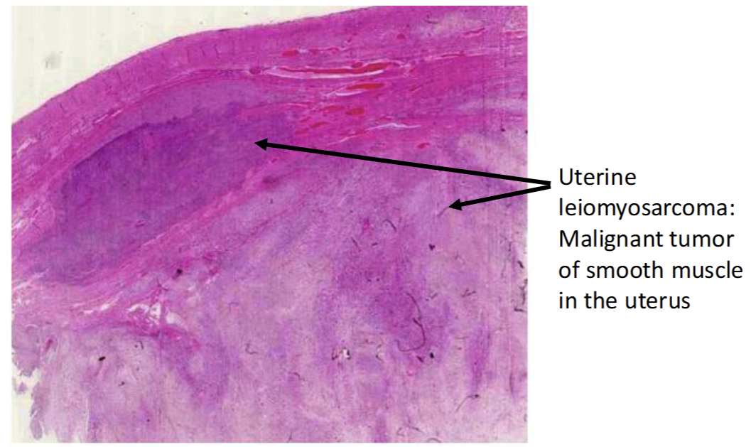 <p>Malignant Tumor</p><ul><li><p>Poorly defined boundaries that can exhibit disruption with infiltration of cells into surrounding tissue</p></li><li><p>exhibit more abnormal apperances including large nucleus, loss of normal cellular structures, and loss of normal organization with neighboring cells</p></li></ul><p></p>