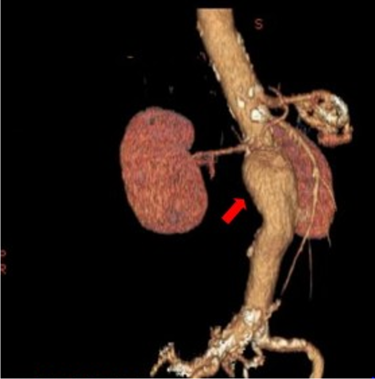 <p>What does this CT angiography refer to</p>