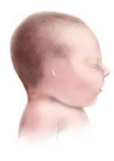 <p>what <span>is known as absence of the pinna. Below is an image that shows this congenital condition? </span></p>