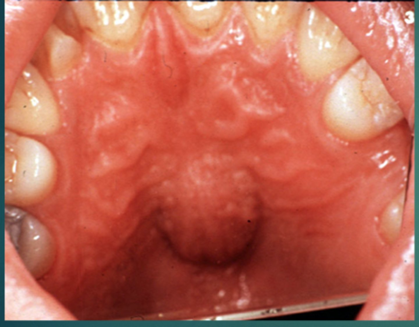 <p>more posterior form of nasopalatine canal cyst</p><p>• not heart-shaped</p>