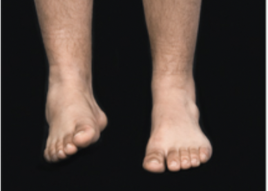 Turning the sole (plantar surface) of foot medially