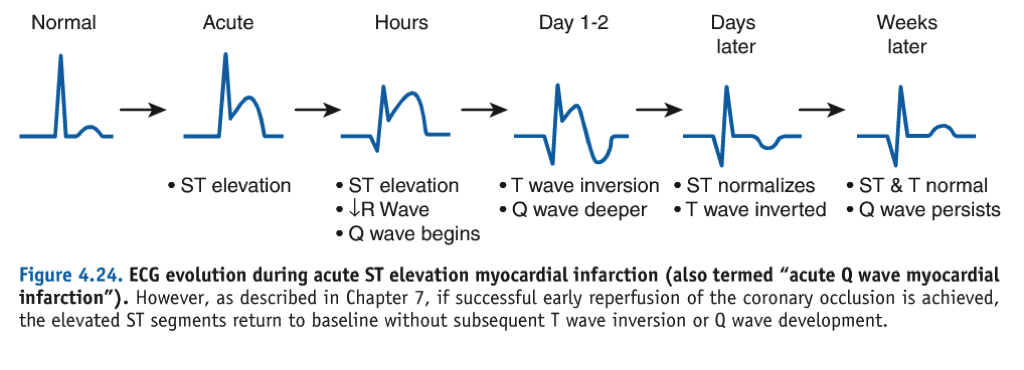 <p>Hyperacute T-waves → ST-elevation → Pathological Q-wave formation → T-wave inversion → ST normalization → T-wave normalization.</p>