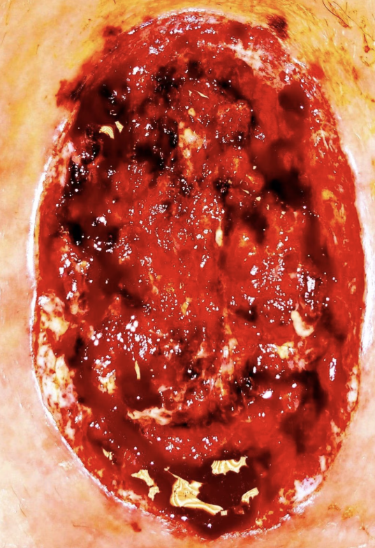 <p>what type of secondary lesion is this? (alteration to skin integrity)</p>