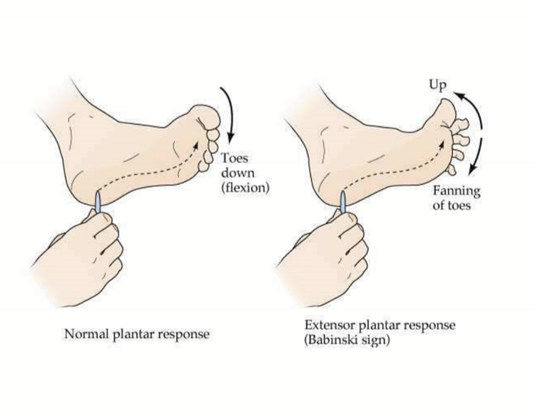 <ul><li><p>Spastic paralysis/paresis </p></li><li><p>Hypertonia: Abnormally high level of muscle tone</p></li><li><p>Hyperreflexia: Overactive reflexes </p></li><li><p>Fasciculations: involuntary twitching </p></li><li><p>Positive Babinski Sign: fanning of toes from extensor plantar response </p></li></ul><p></p>