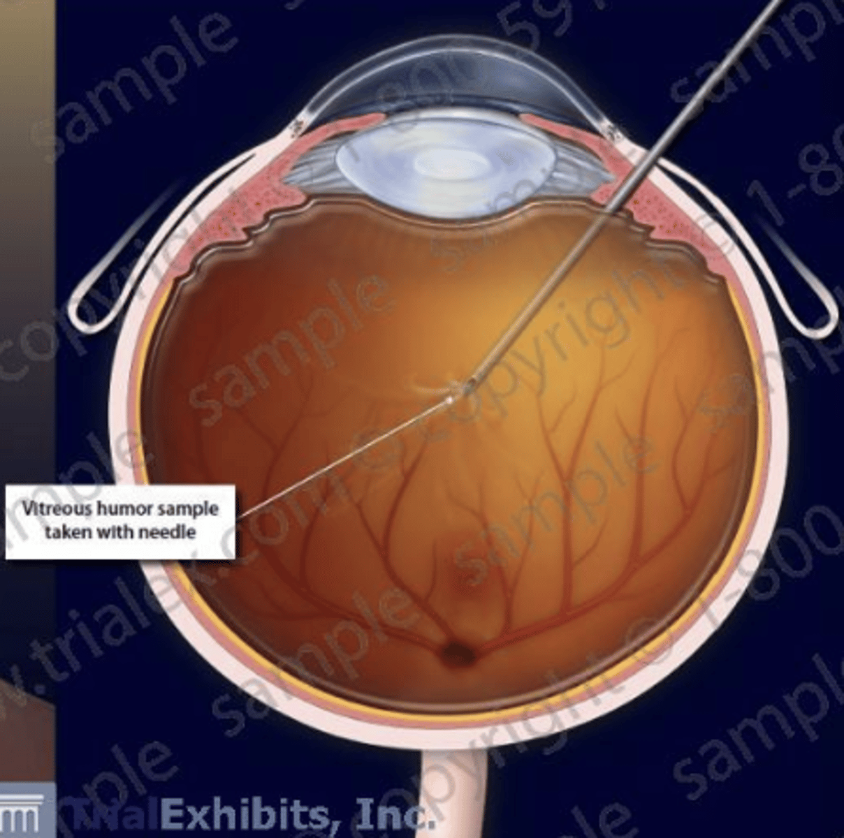 <p>What should be done if there's suspected microbial endophthalmitis (infection/inflammation inside eyeball)</p>