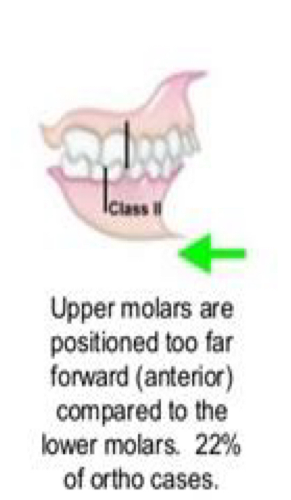 <p>Mandibular teeth positioned back relative to maxillary </p>