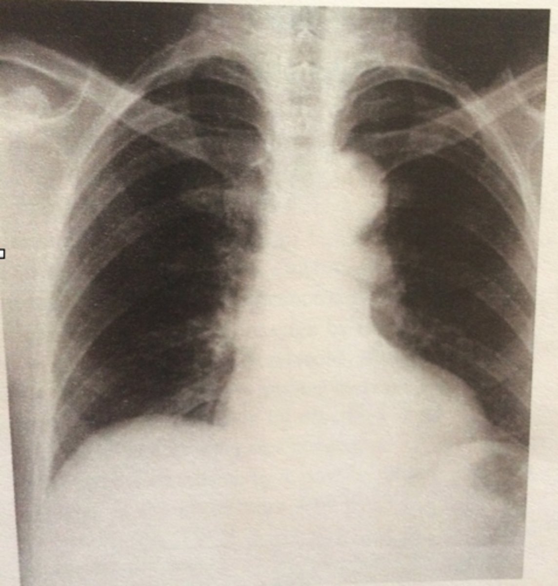 <p>Is this inhalation or exhalation?</p>