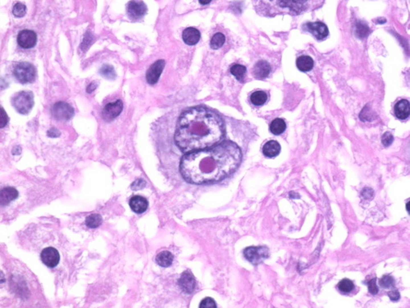 <p>lymphocytes are large and have miotic figures and multiple nucleoli</p>