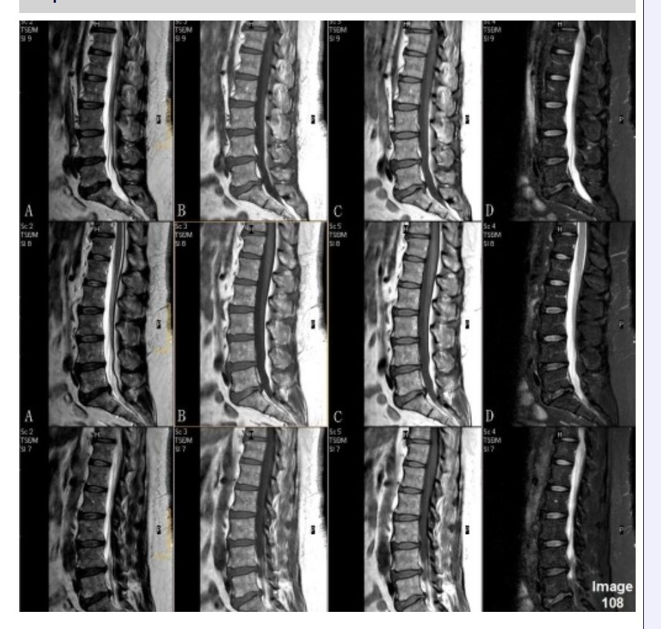 <p><span>Column A in Image 108 corresponds to which MRI pulse sequence?</span></p><p><span>&nbsp;A. Proton density</span></p><p><span>&nbsp;B. T1 weighted</span></p><p><span>&nbsp;C. T2 weighted</span></p><p><span>&nbsp;D. T2 FLAIR</span></p><p><span>&nbsp;E. STIR</span></p>