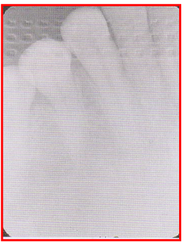 <ul><li><p>Image appears light with a HERRINGBONE pattern across the film (tire-tracks/waffle image)</p></li><li><p>Herringbone pattern is the actual pattern embossed on the lead foil. </p><ul><li><p>Reason: Film was placed in the mouth backwards </p></li></ul></li><li><p>Fix: ensure the proper side of the film is placed facing the PID</p></li></ul><p></p>
