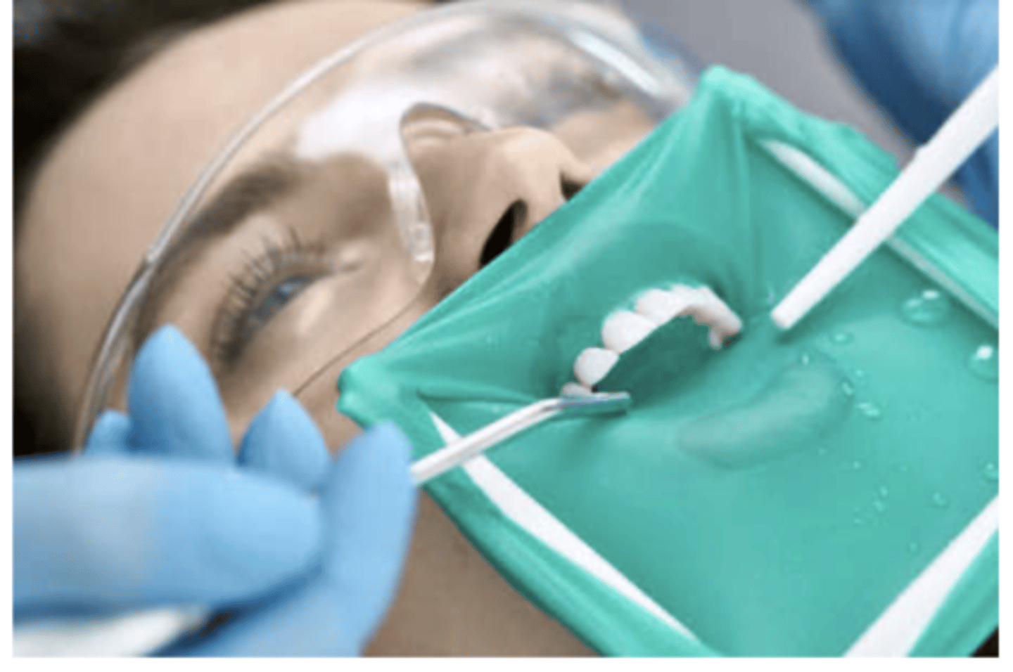 <p>Considered the gold standard of isolation</p><p>Can be used for both maxillary and mandibular arches</p>