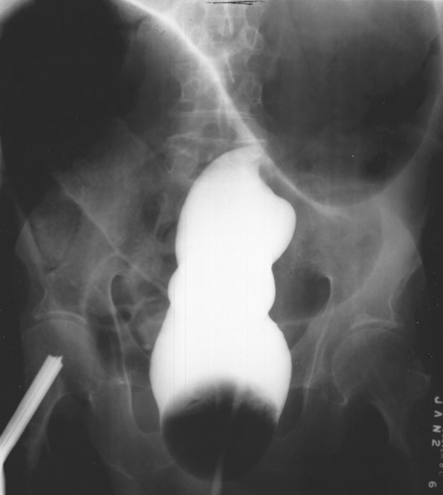 <p>How does cecal volvulus occur?</p>