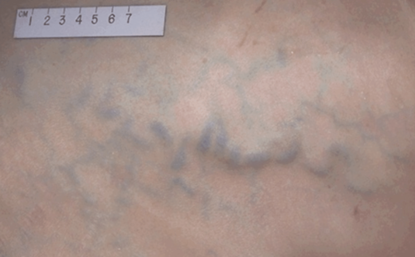 <p>A condition characterized by distended veins around the navel due to portal hypertension.</p>