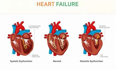 <p>What’s the difference between HFrEF and HFpEF? </p>