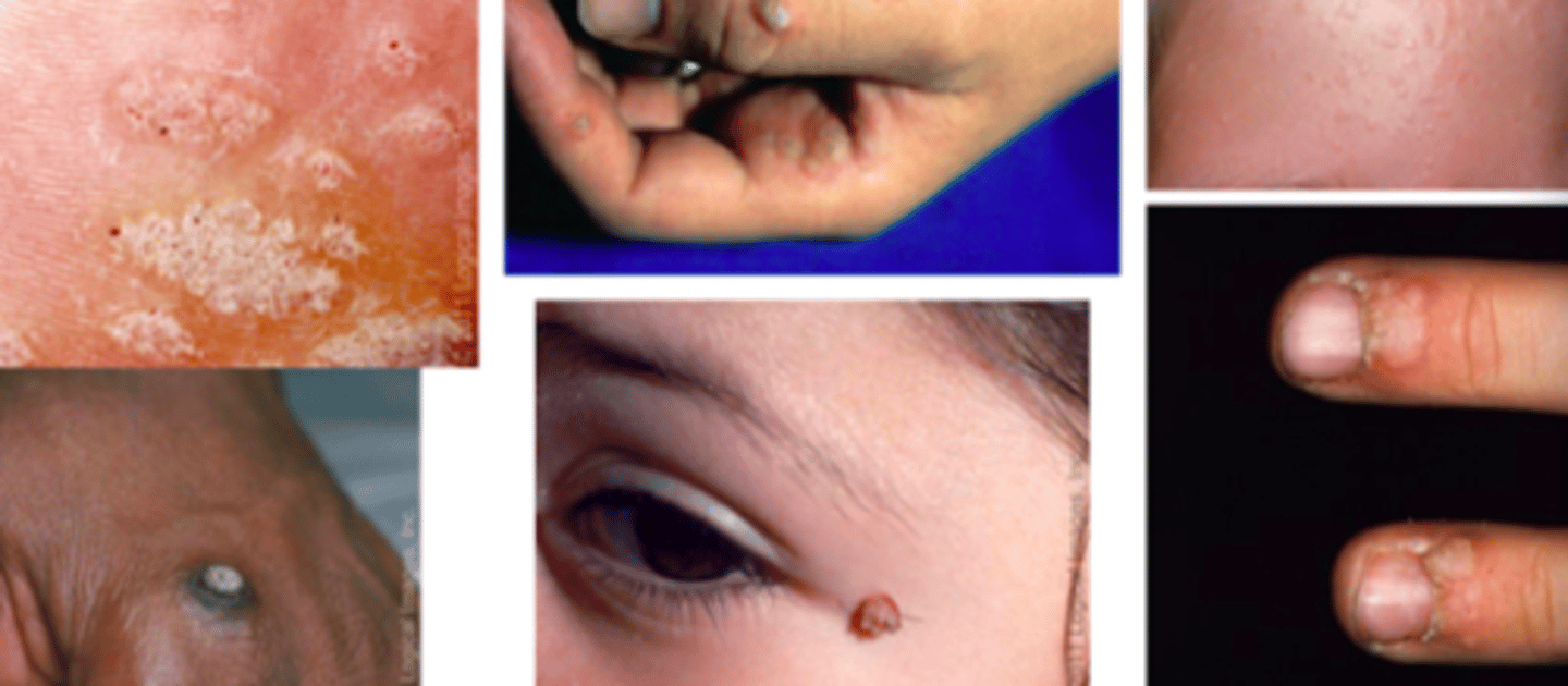 <p>Viral ID:</p><p>Objective:</p><p>- Cutaneous warts may manifest as common warts (verruca vulgaris), plantar warts (verruca plantaris) and flat warts (verruca plana)</p><p>- May occur singly, in groups, or as coalescing warts forming plaques</p><p>Diagnosis based on clinical appearance:</p><p>- Flesh-colored papules may be smooth or slightly hyperkeratotic</p>