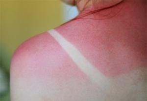 <ul><li><p>Superficial burn</p></li><li><p>Only epidermis is damage</p></li><li><p>Skin is red and swollen (sunburn)</p></li></ul><p></p>
