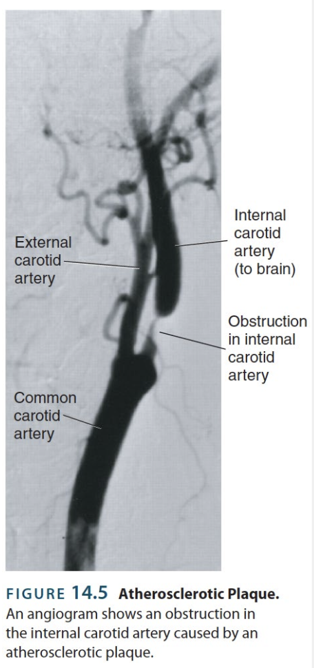 <p>→ process in which lining of arteries develop a layer of plaque (deposits of cholesterol, fats, calcium, and cellular waste products), which narrow vessels and increase the risk of stroke</p><ul><li><p>Precursor to <strong>myocardial infarctions</strong> (<strong>heart attacks</strong>) and <strong>strokes</strong></p></li><li><p>Atherosclerotic plaques often form in the <strong>internal carotid artery</strong> (leads to the brain)</p></li></ul><p></p><p><u>Diagnostics</u>: </p><ul><li><p>Visualized with an<strong> angiogram</strong> → produced by injecting a radiopaque dye into the blood and examining vessels with x-ray imagery</p></li><li><p>Risk factors include vulnerable age groups, ↑ BP, smoking, diabetes, ↑ cholesterol levels, poor diet, lack of exercise, obesity, etc.</p><p></p></li></ul><p></p><p></p>