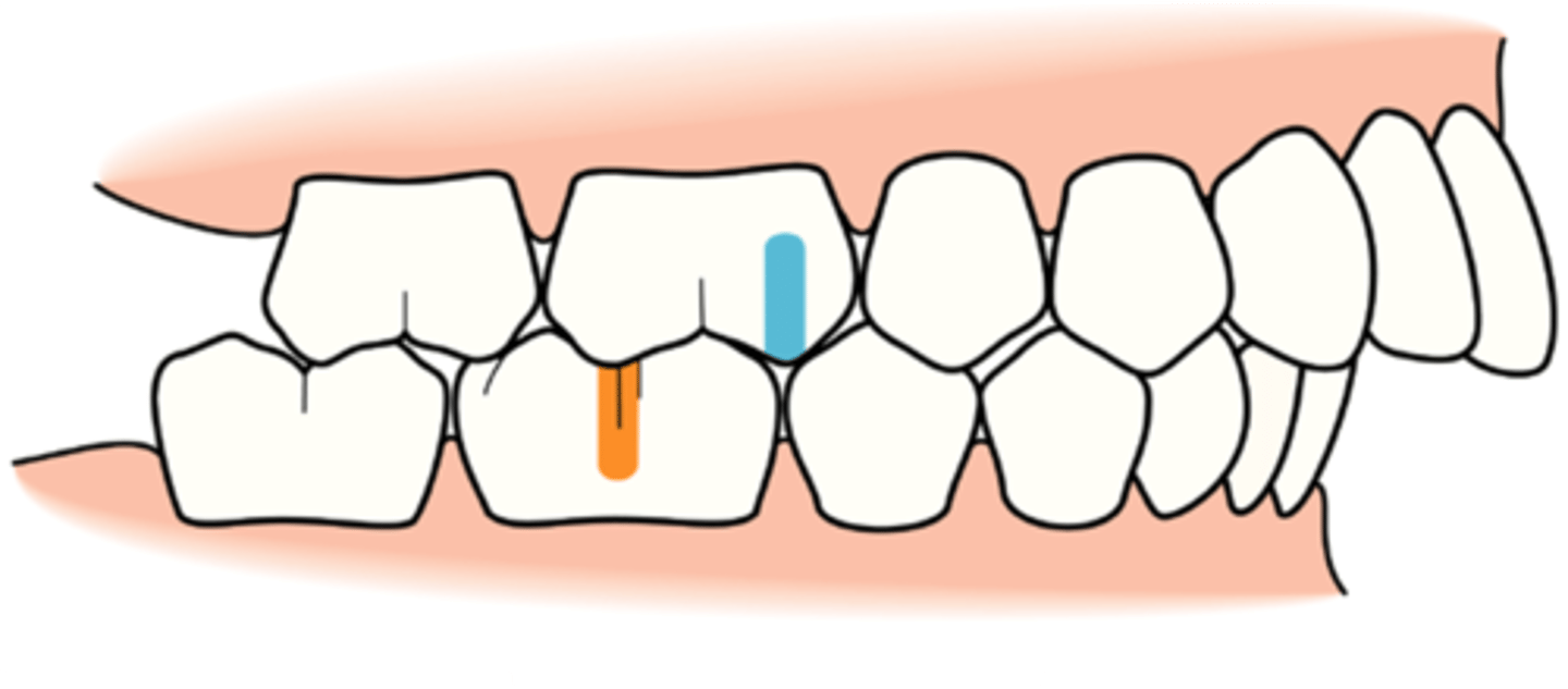 <p>(Retrognathic)</p><p>Molar Relationship: Buccal groove of the mandibular first permanent molar is distal go the mesiobuccal cusp of the maxillary first permanent molar by at least the width of a premolar.</p><p>Canine Relationship: Distal portion of the maxillary canine is mesial to the mesial portion of the mandibular canine by at lease the width of a premolar.</p><p>Division I-retruded mandible with one or more maxillary anterior teeth protruded facially.</p><p>Division II- retruded mandible with one or more maxillary anterior teeth inclined lingually.</p>