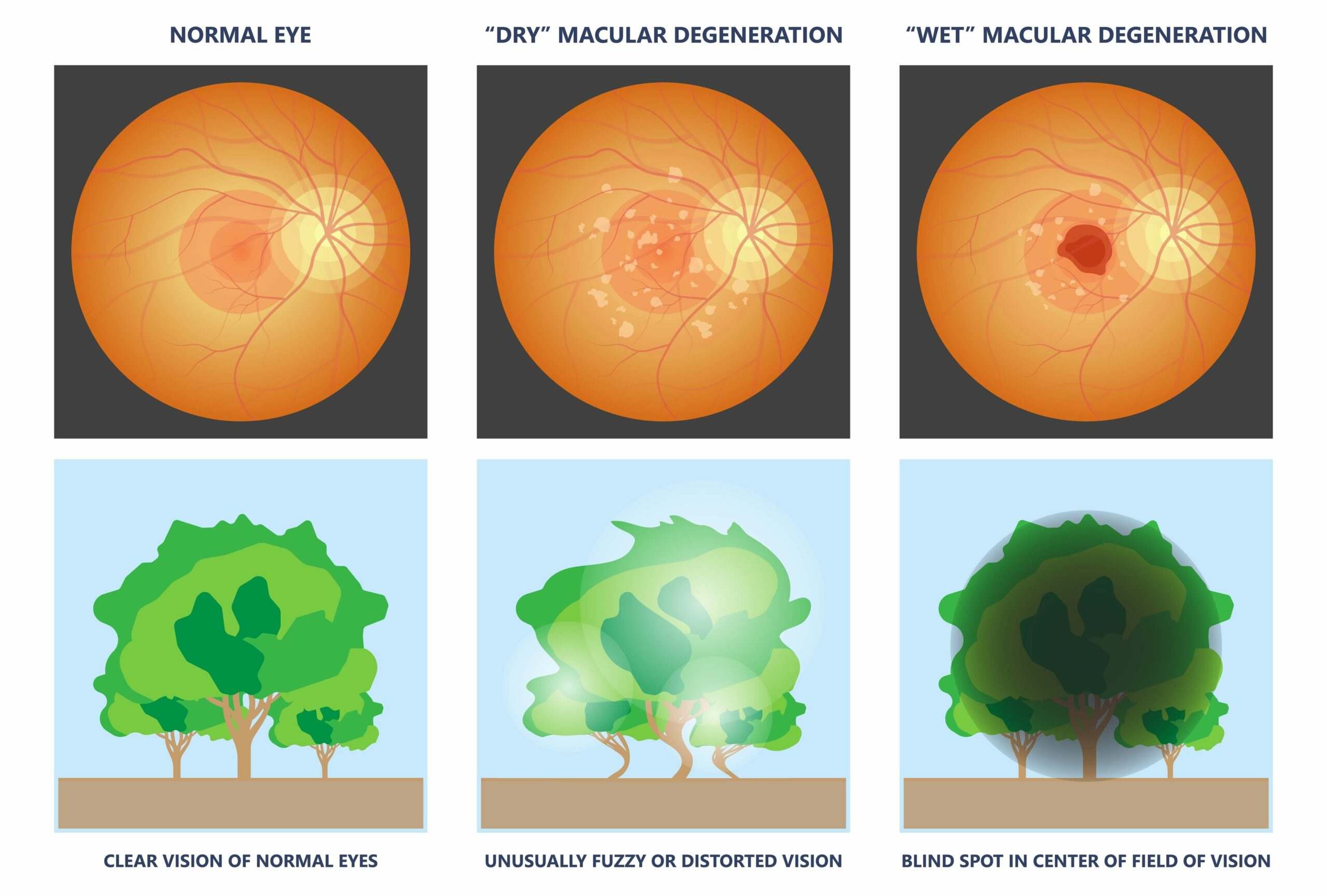 <p>What is macular degeneration?</p>