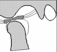 <p>disc displaced and RETURNS to normal position when jaw opens</p>